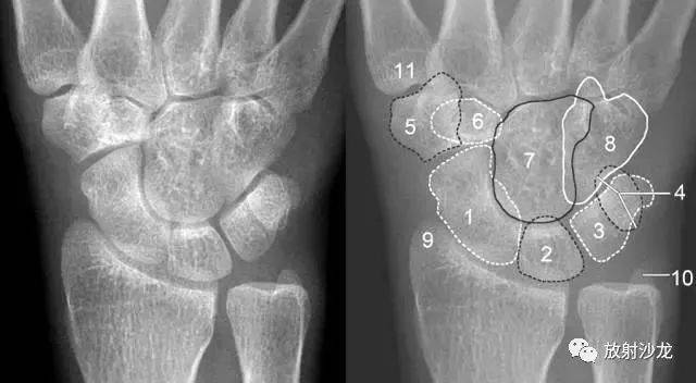 详细的腕关节x线解剖 摄影技巧 阅片技巧 测量