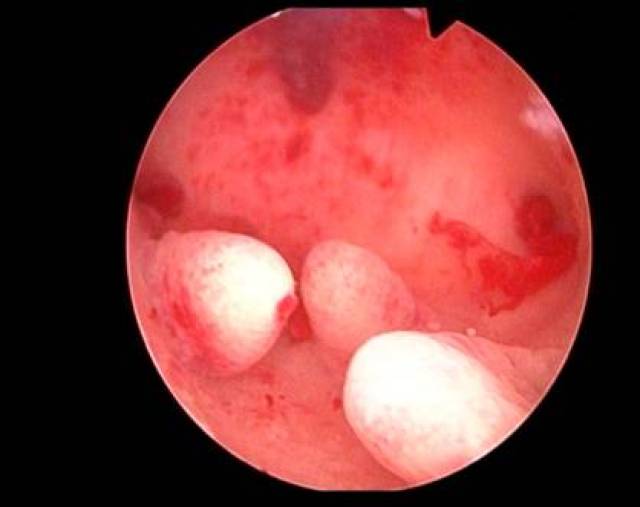 宫腔镜下见粘膜下肌瘤