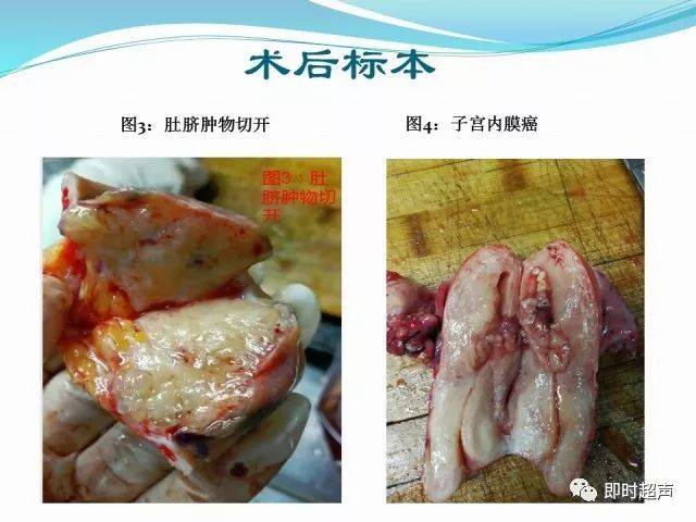 容易被忽视的疾病——玛丽约瑟夫结节