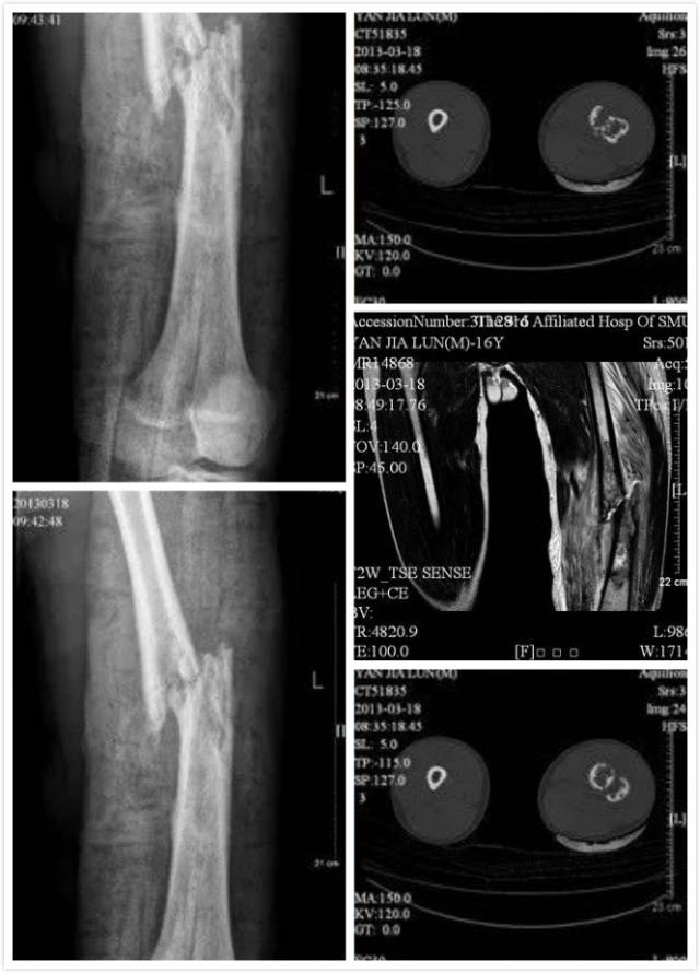 病例分享 一例股骨骨肉瘤病理骨折