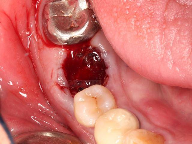 恒牙掉了怎么办?马上做这些事!