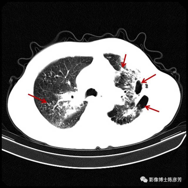 肺纤维灶图片