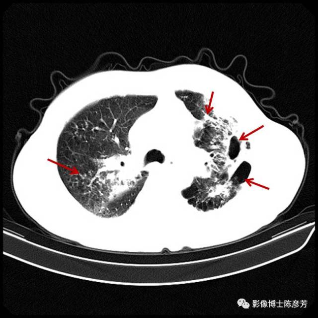 肺纤维灶图片图片