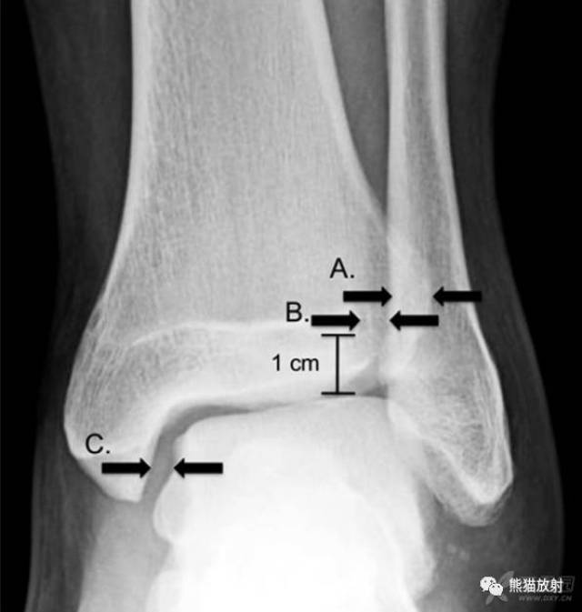 胫骨X线侧位片解剖图图片