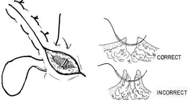 间断缝合法图解图片