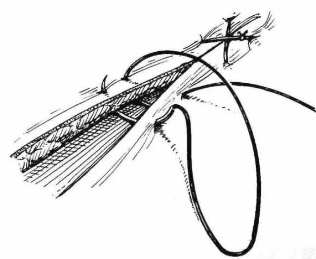 医学缝合针法图片