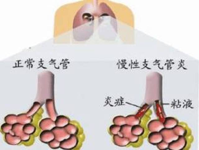 不控制可致慢阻肺慢性支氣管炎是一種很常見的疾病,它是支氣管壁的