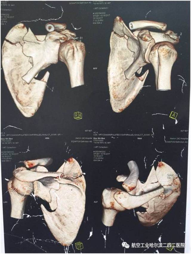 肩胛骨畸形手术图片