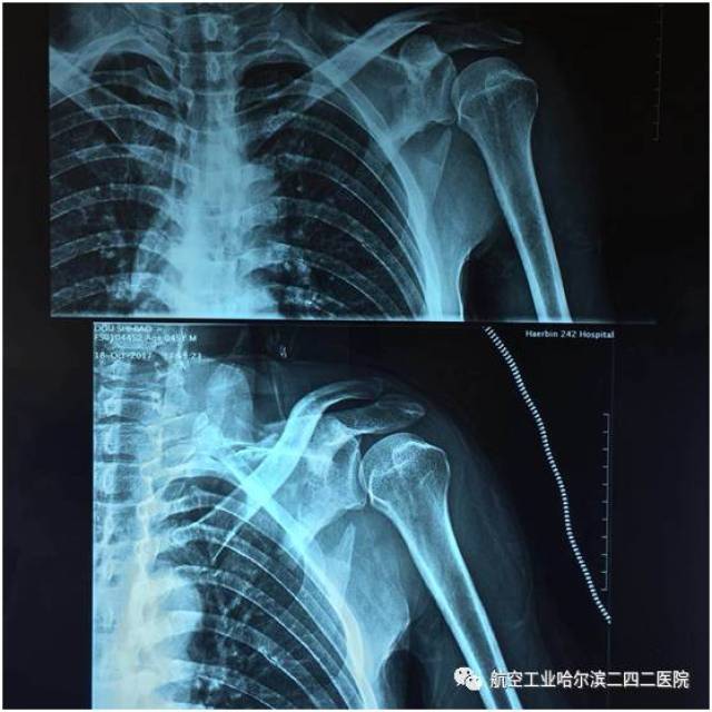 经影像学检查可见 ct 左肩胛骨粉碎性骨折