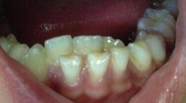 7岁男孩乳牙滞留,长出了双排牙,得知原因后孩子妈很是后悔