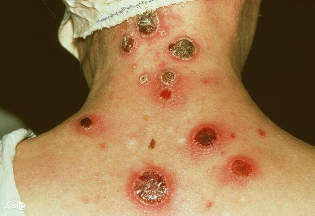 梅毒抗体阳性=梅毒?_手机搜狐网