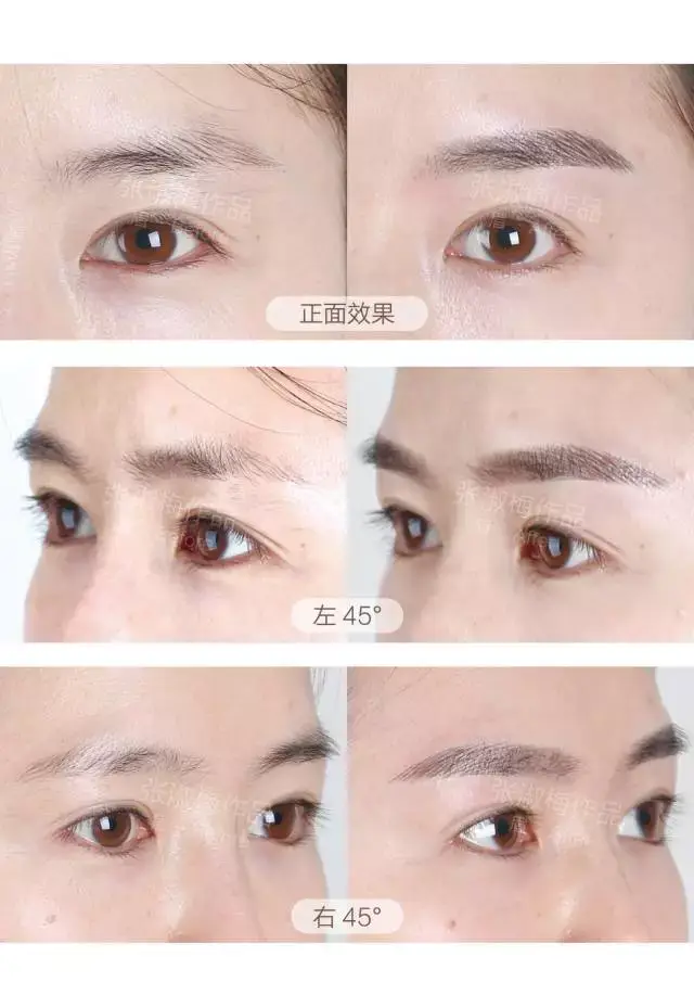 治疗效果展示 近距离来看看吧 线条流畅,丝丝挺立 跟自己的眉毛并没有