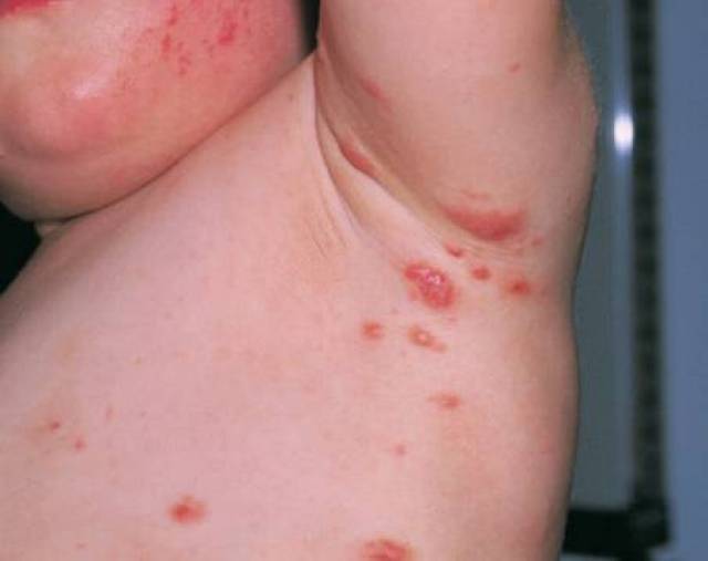 墨尔本蜱虫大量出没,有人被咬后瘫痪,预防措施都在这了!