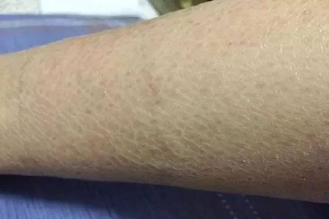 健康脱下秋裤抖落一地的皮屑只因皮肤缺水还要当心鱼鳞病