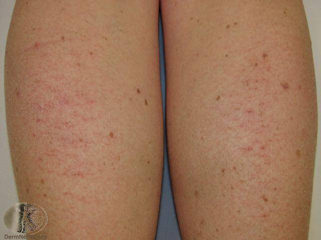 孩子身上疑似被扎针的部位有可能是干性湿疹吗?