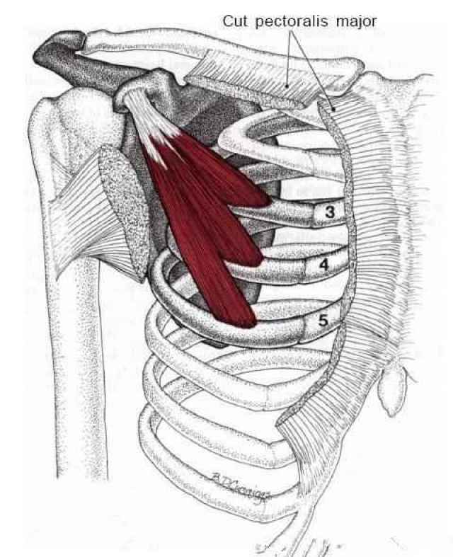 你有上交叉综合症吗? 得了上交叉综合症该怎么