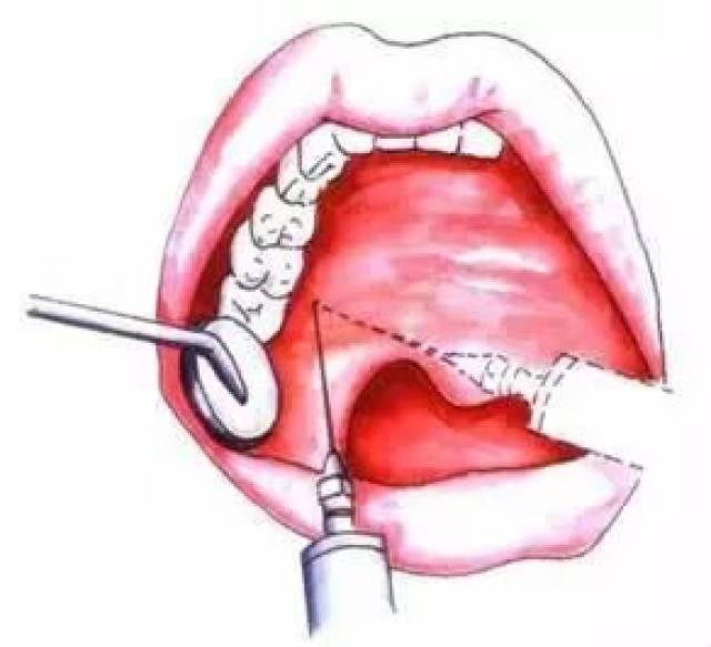 口腔麻醉进针图示图片
