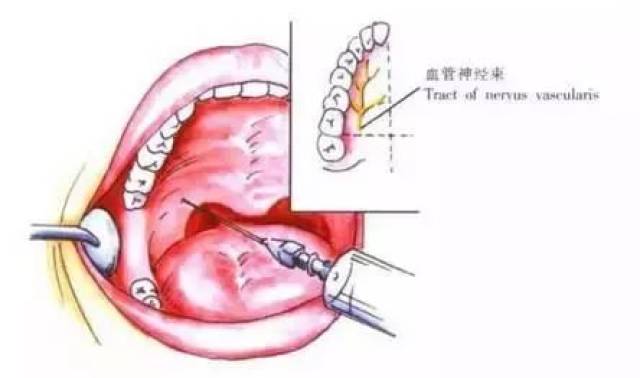 口腔前庭沟进针点图片图片