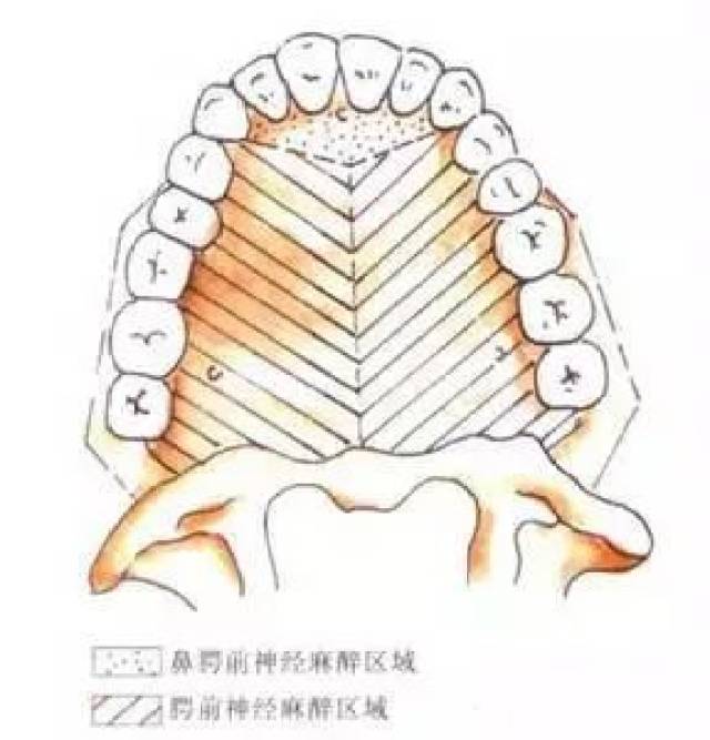 口腔麻醉区域图图片