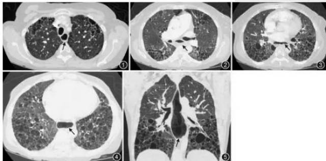 蜂窝肺常被认为是肺纤维化的特征表现,并且为诊断寻常型间质性肺炎的