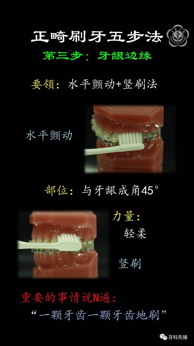 【视频】正畸时如何刷牙?用牙线?牙间刷?