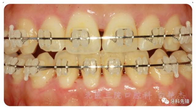 【视频】正畸时如何刷牙?用牙线?牙间刷?