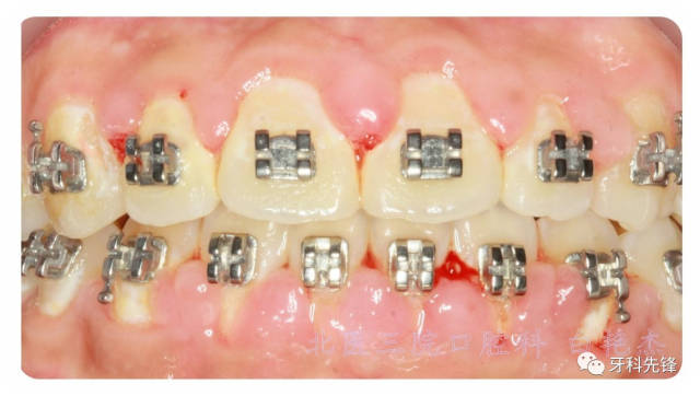【视频】正畸时如何刷牙?用牙线?牙间刷?