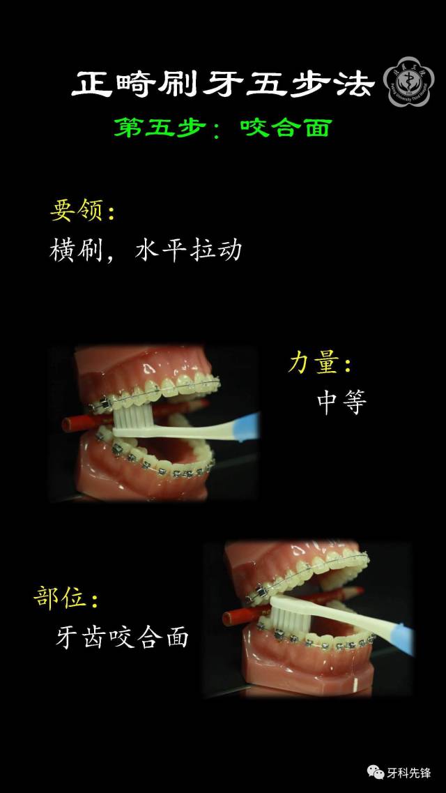 【视频】正畸时如何刷牙?用牙线?牙间刷?