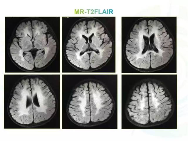 诊断:异染性脑白质营养不良(metachromatic leukodystrophy,mld)