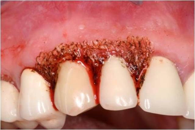1,牙齦增生盲目種植牙可能會引發以下危害