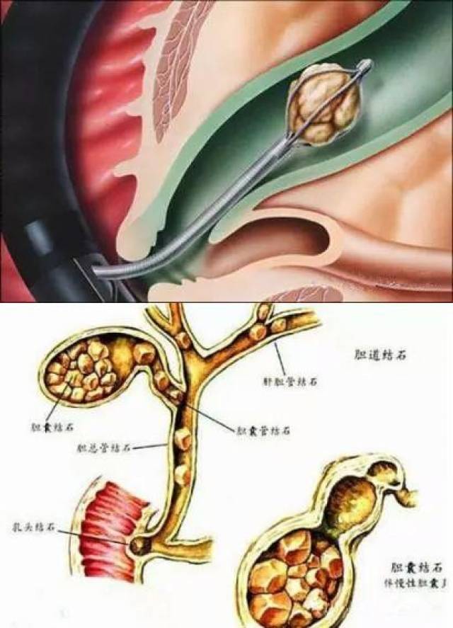 將微創理念發揮極致,普外二科掌握膽道外科核心技術(ercp)!