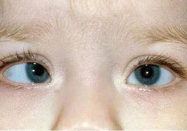 就医搜| 斜视不仅影响视力还会影响全身骨骼发育儿童斜视该怎么办？_ 