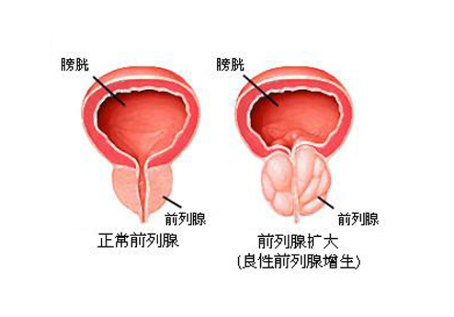 盤點男人前列腺肥大的6種常見症狀及危害