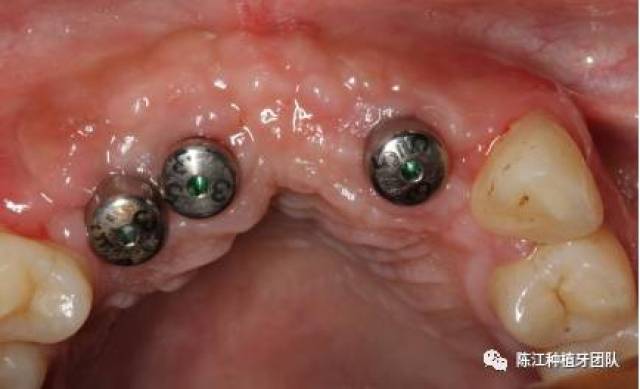 【病例分享】帐篷螺钉和钛网在上颌前牙区骨增量同期牙种植中的应用一