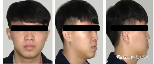 修复后侧面相,可见上唇的丰满度得以改善.