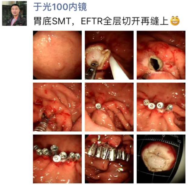 一例胃底smteftr全层切开缝合术的探讨和反思