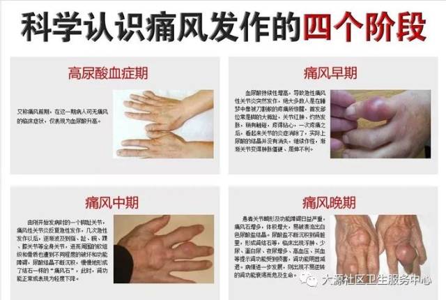 [健康宣教]一图告知痛风离你有多远?