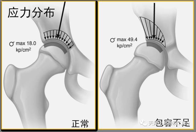 髋臼ce角正常值图片