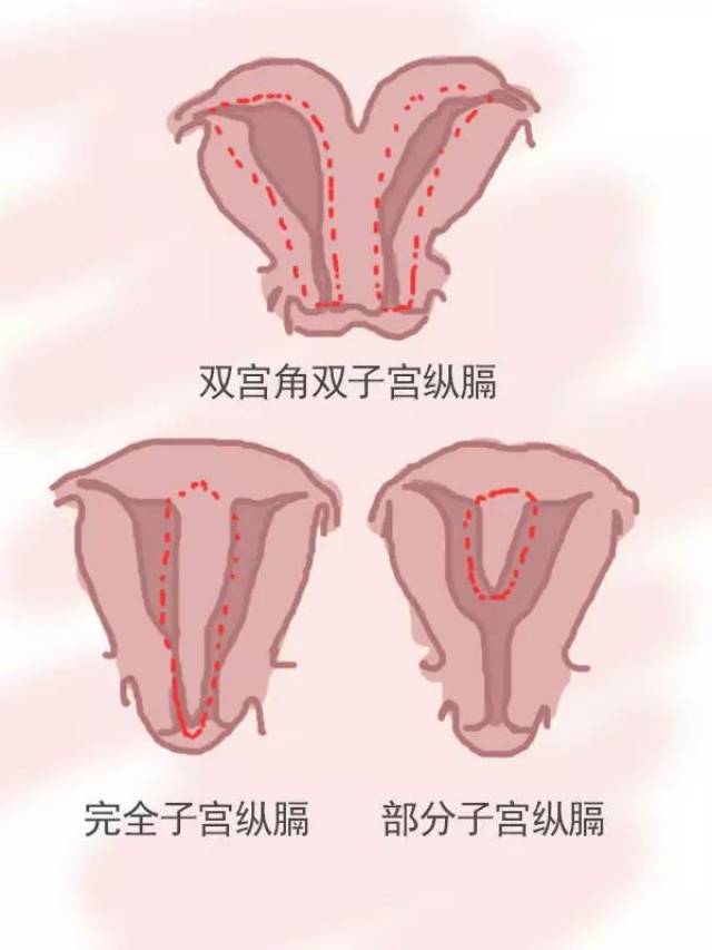 子宮縱膈手術能報銷嗎 子宮縱隔醫保