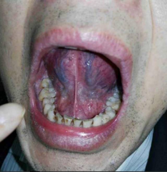 通常会说舌苔薄,舌苔厚,舌苔腻之类,但很少有人观察过自己舌头的腹侧