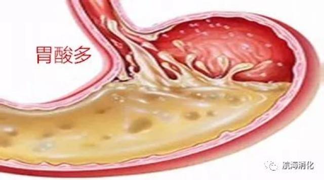 当胃酸分泌增多到一定程度,产生腹痛,泛酸,烧心,嘈杂等表现,如到医院