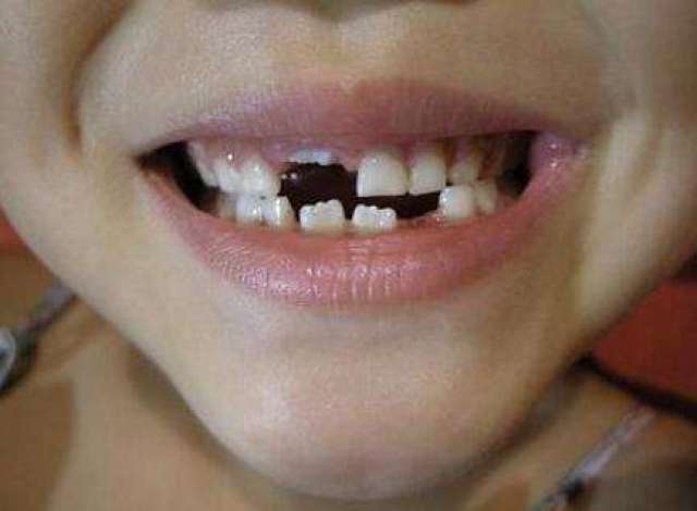 患者:孩子一颗牙齿被蛀掉了一半该怎么办?