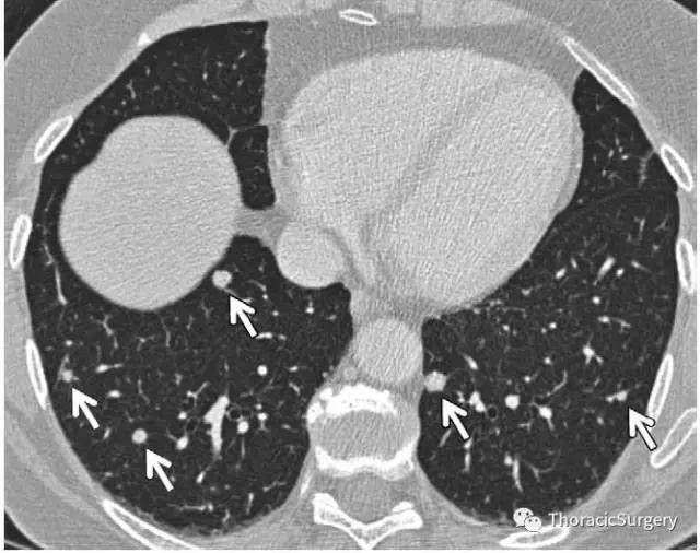 Fleischner:CT偶发性肺结节处理原则
