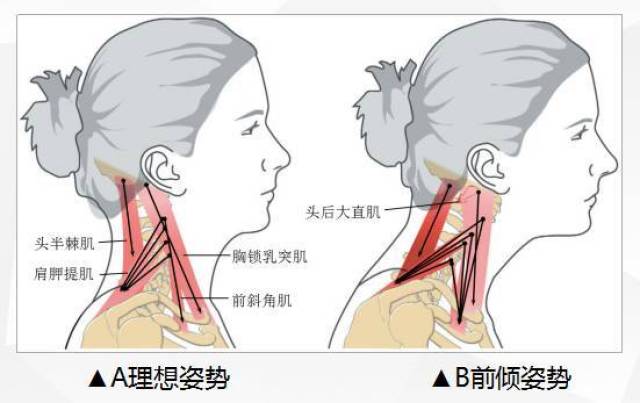 颈屈肌图片