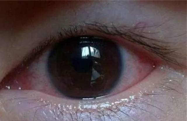 眼红,流泪,分泌物多,眼屎反映宝宝眼睛健康状况
