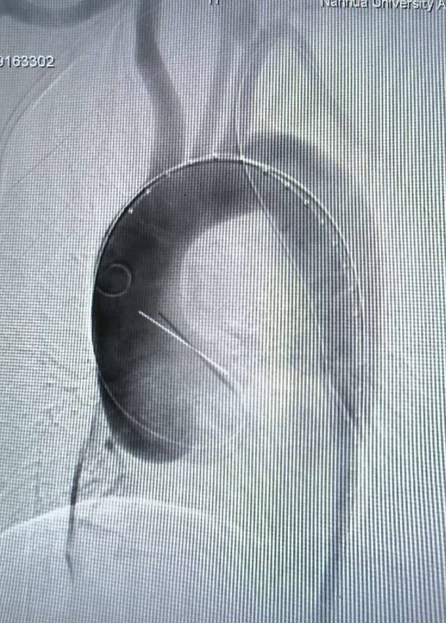 心脏造影 支架图片
