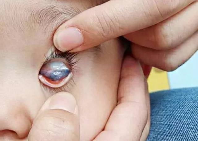 专家在线丨宝宝眼内发黑要重视,可能存在恶性病变的风险!