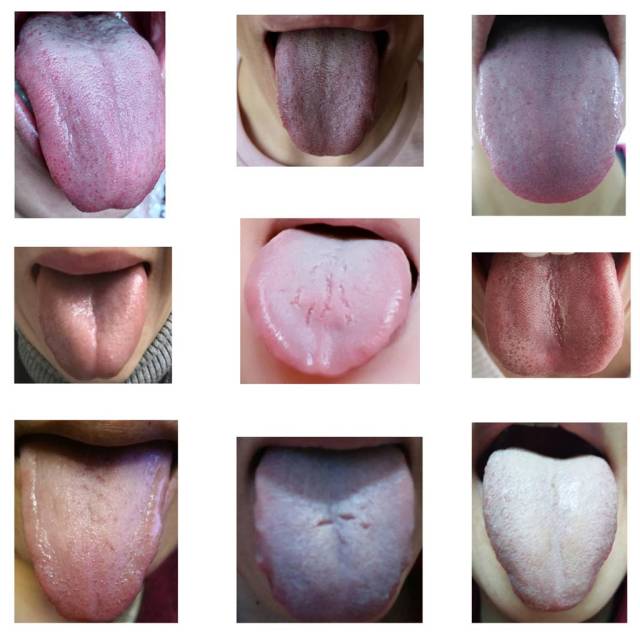 正常舌苔的颜色疾病图片