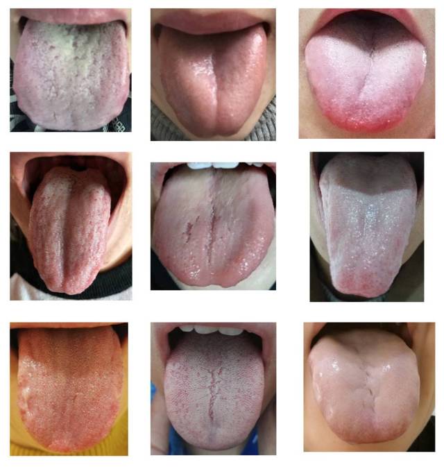 一个健康的舌苔应是 粉红色,薄白苔 舌之伸舒,常人自如 自元气家族