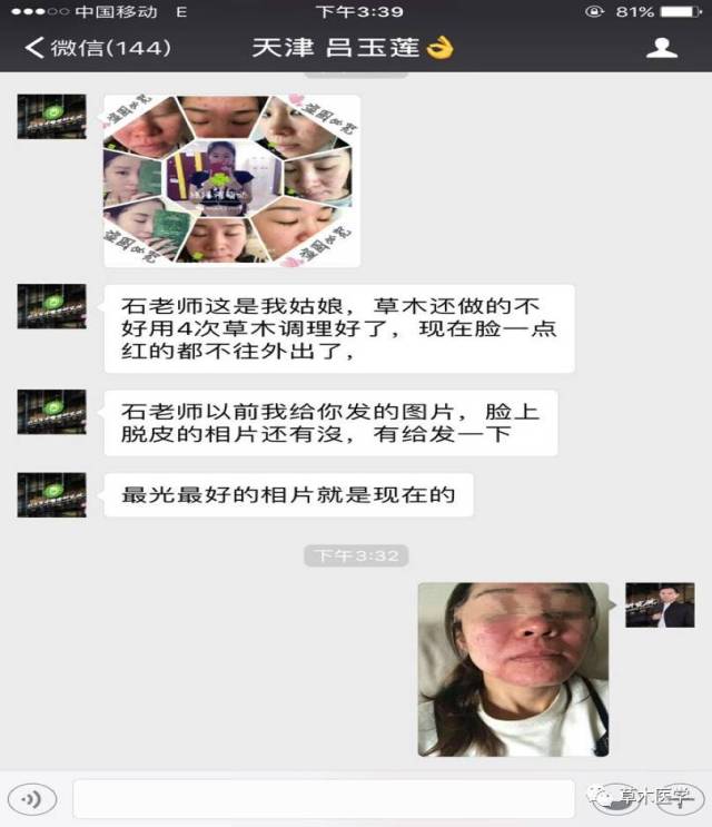 天津治疗湿疹